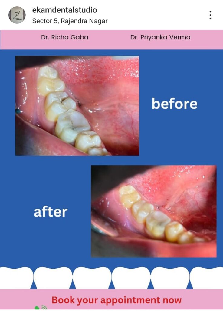 Dental Cleaning