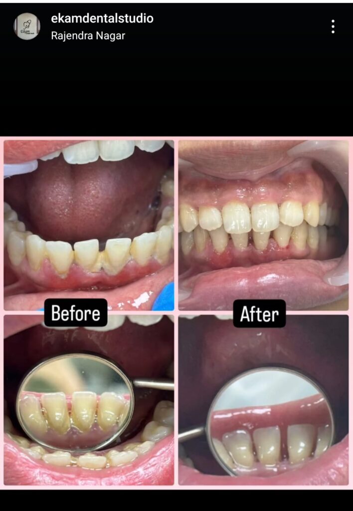 Dental polishing
