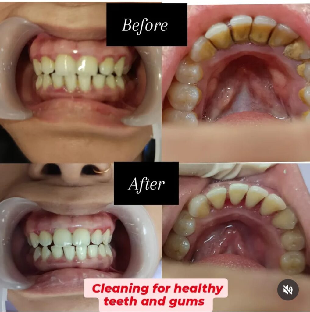 Teeth Whitening, Cleaning